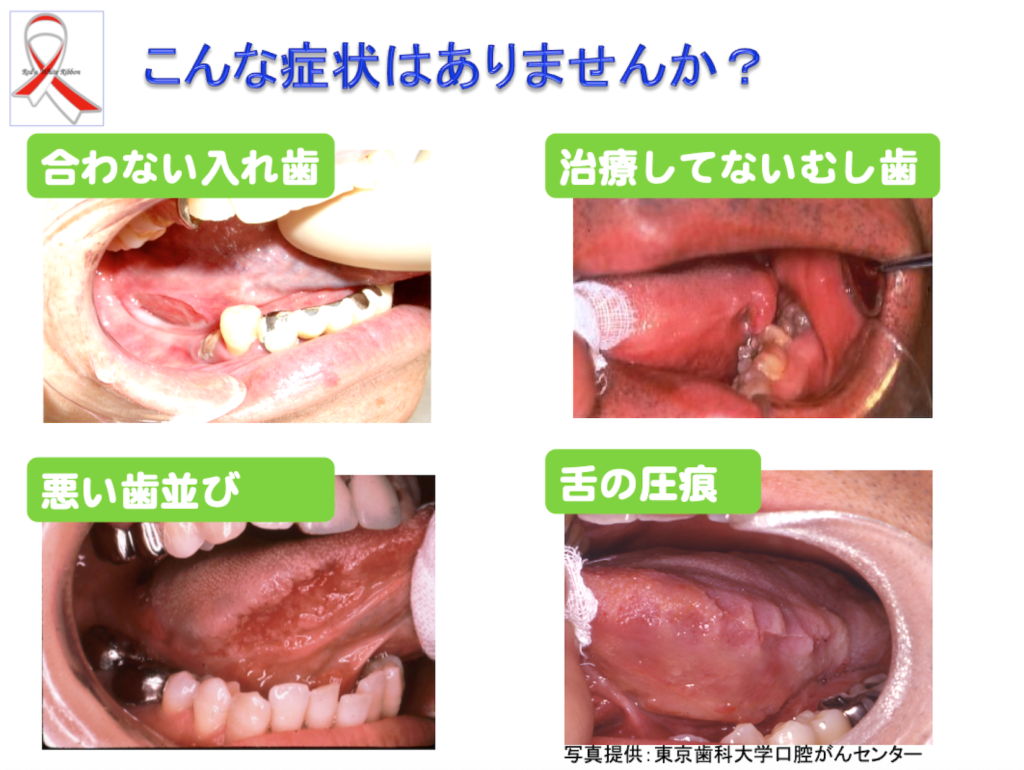 舌 の 裏 口内炎 原因